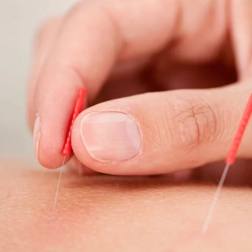 Chronic Pain Phoenix AZ Acupuncture Needle